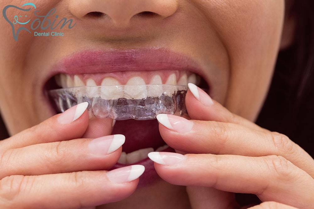 برای جلوگیری از افتادن کامپوزیت دندان، می‌توانید از محافظ‌های دندانی استفاده کنید.